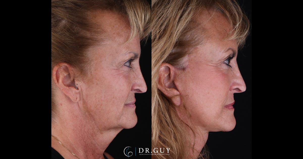 Facelift Before & After Gallery - Patient 405219 - Image 4