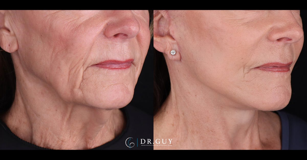 Facelift Before & After Gallery - Patient 129600 - Image 3