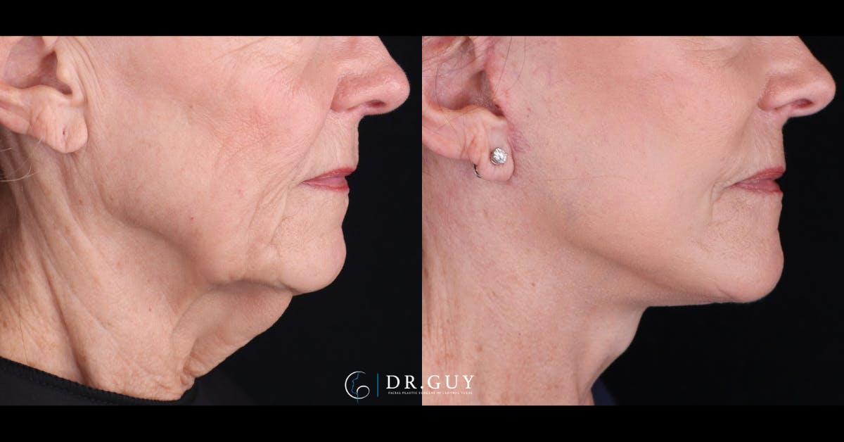 Facelift Before & After Gallery - Patient 129600 - Image 2