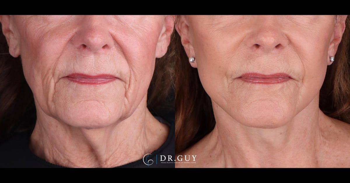 Facelift Before & After Gallery - Patient 129600 - Image 4