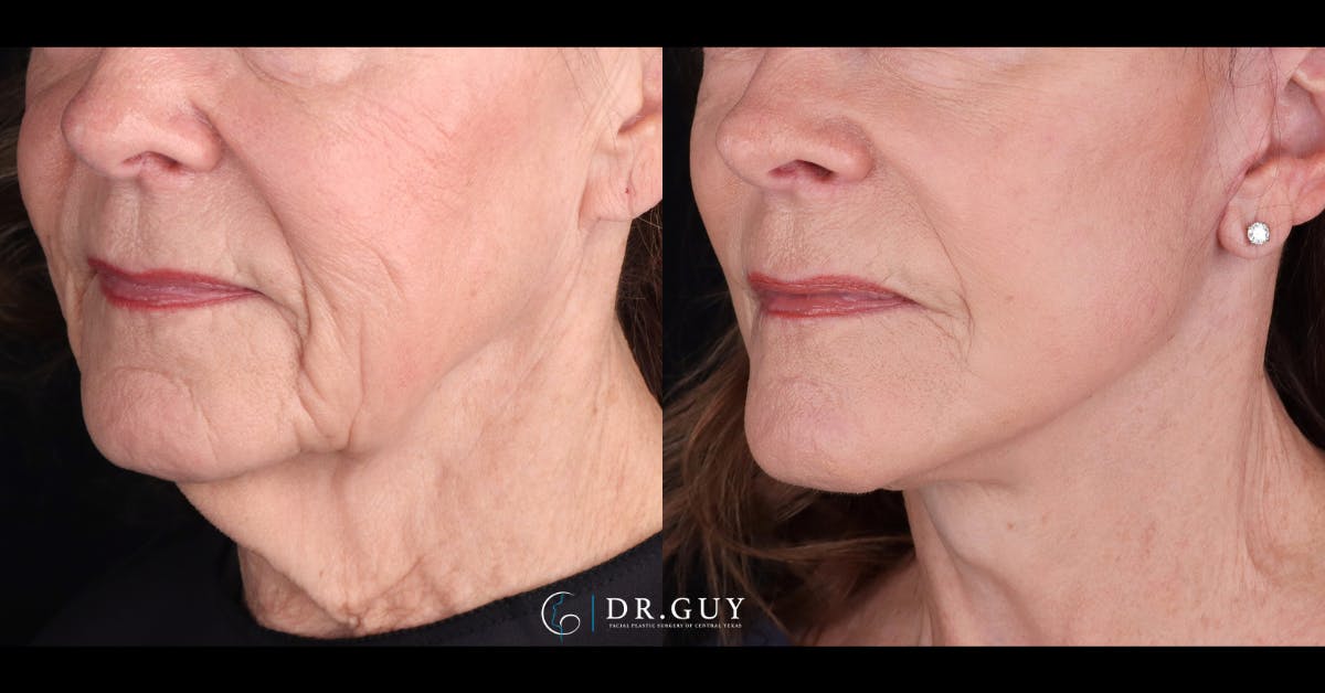 Facelift Before & After Gallery - Patient 129600 - Image 5