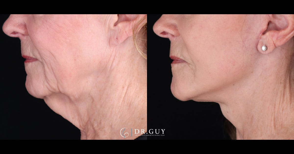 Facelift Before & After Gallery - Patient 129600 - Image 1