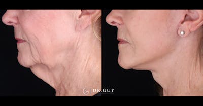Facelift Before & After Gallery - Patient 129600 - Image 1