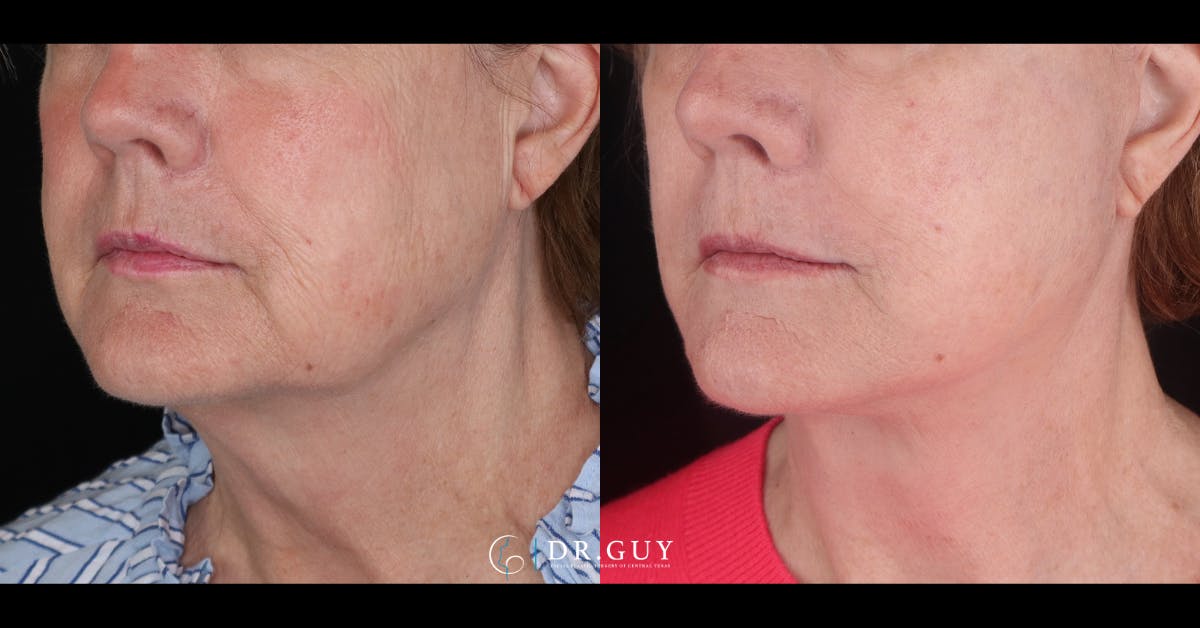 Facelift Before & After Gallery - Patient 229193 - Image 2