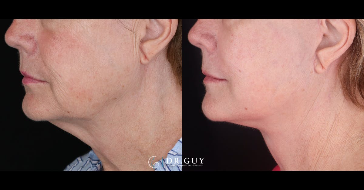 Facelift Before & After Gallery - Patient 229193 - Image 4