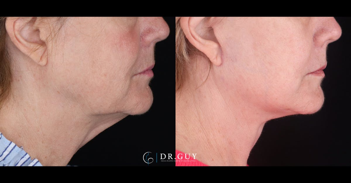 Facelift Before & After Gallery - Patient 229193 - Image 3