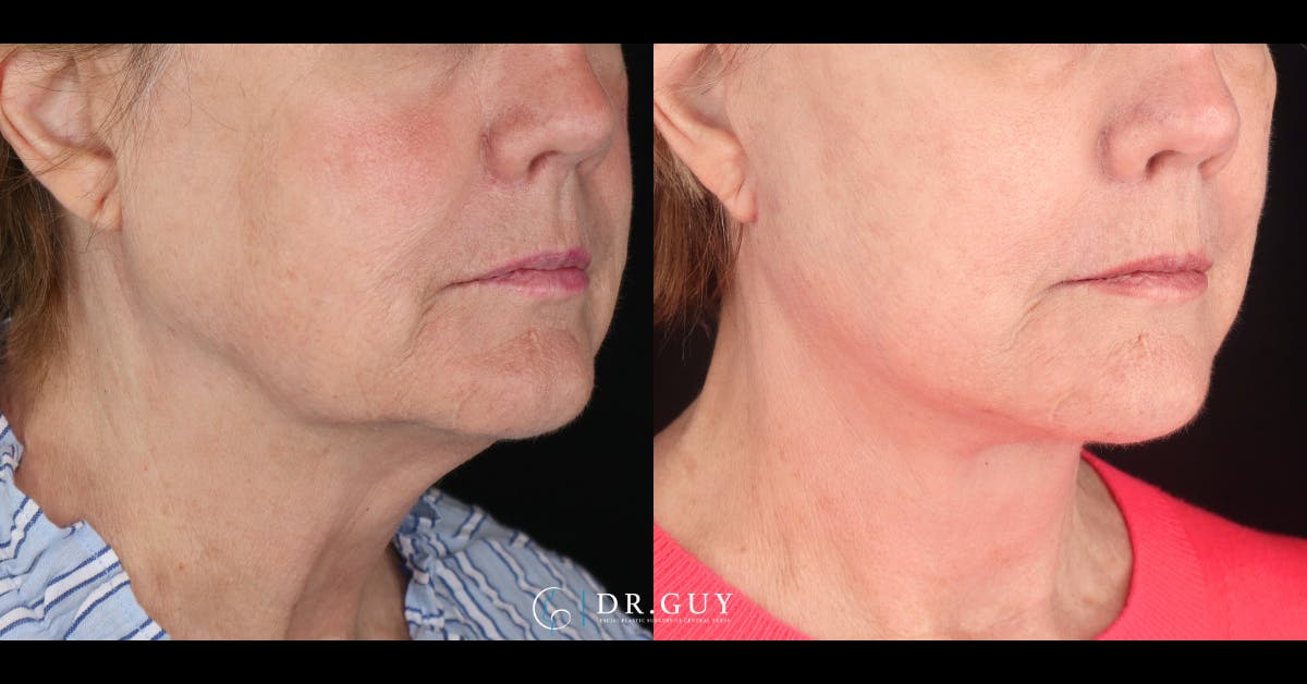 Facelift Before & After Gallery - Patient 229193 - Image 1