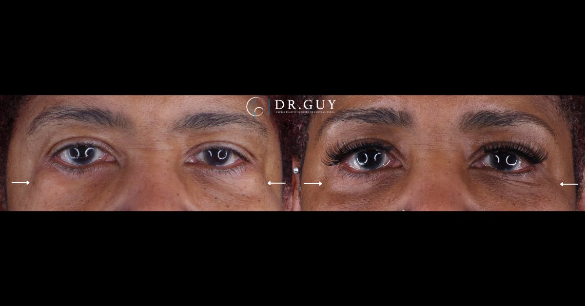 Lower Blepharoplasty Before & After Gallery - Patient 354711 - Image 1