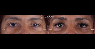 Lower Blepharoplasty Before & After Gallery - Patient 354711 - Image 1