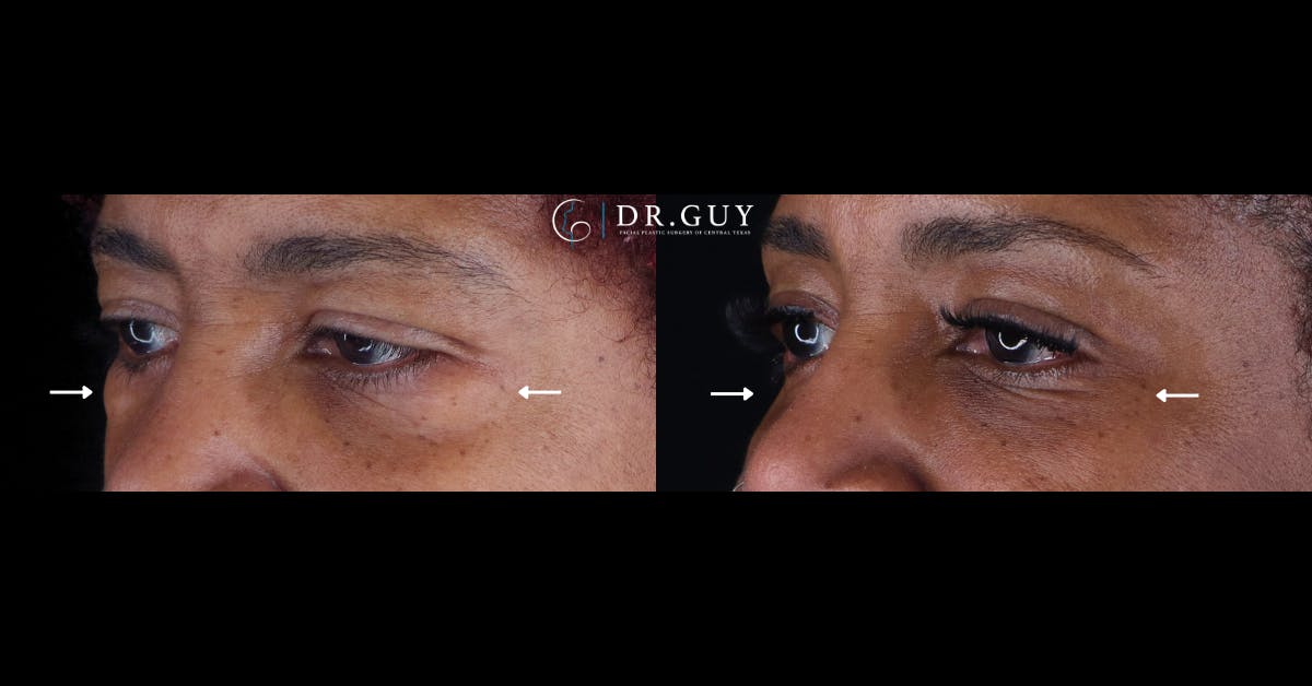 Lower Blepharoplasty Before & After Gallery - Patient 354711 - Image 3