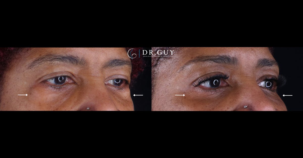 Lower Blepharoplasty Before & After Gallery - Patient 354711 - Image 2