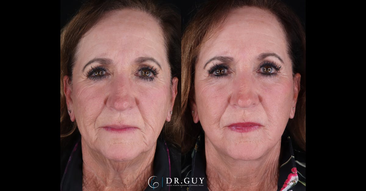 Facelift Before & After Gallery - Patient 363518 - Image 1