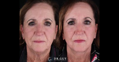 Facelift Before & After Gallery - Patient 363518 - Image 1