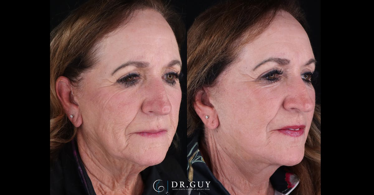 Facelift Before & After Gallery - Patient 363518 - Image 2