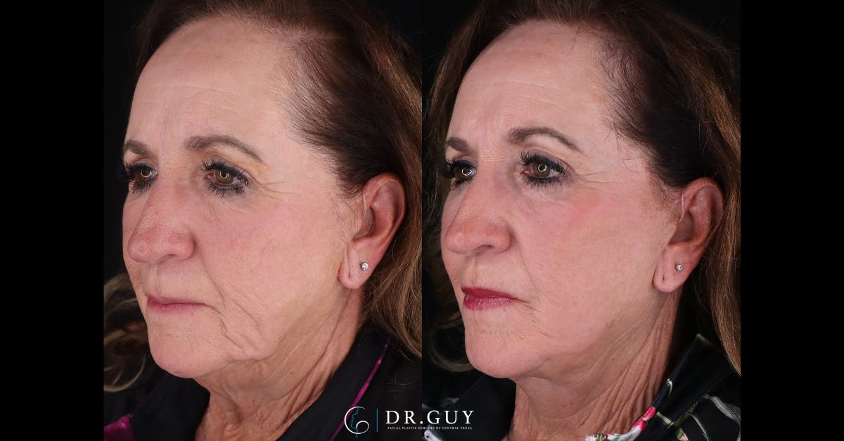 Facelift Before & After Gallery - Patient 363518 - Image 3