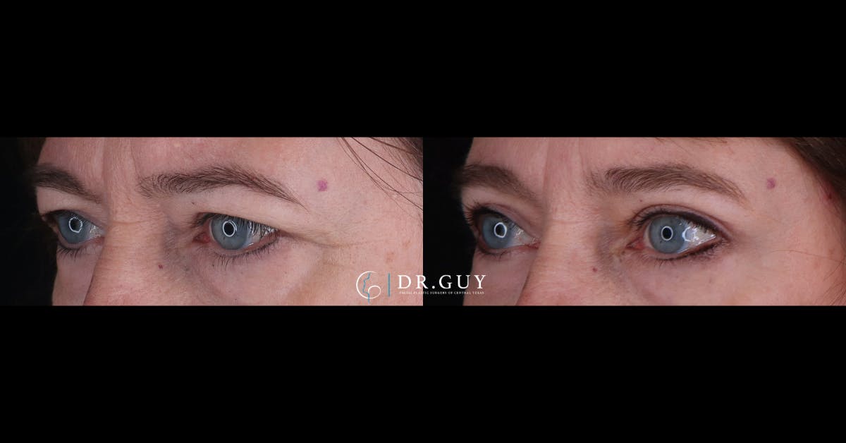 Upper Blepharoplasty Before & After Gallery - Patient 125949 - Image 3