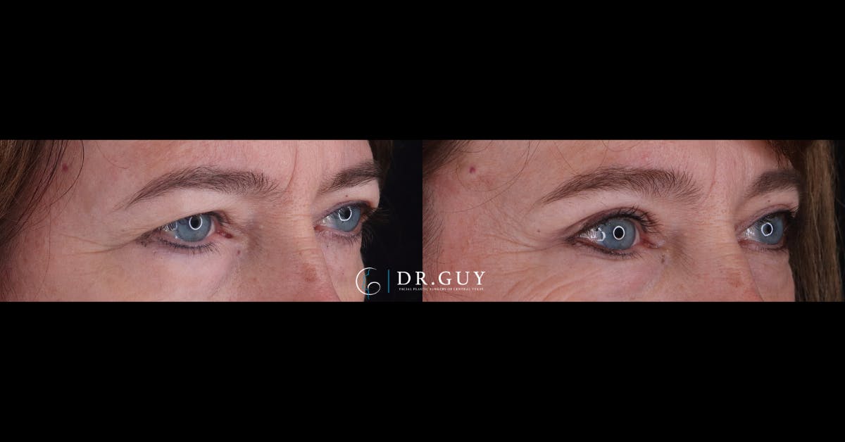 Upper Blepharoplasty Before & After Gallery - Patient 125949 - Image 2