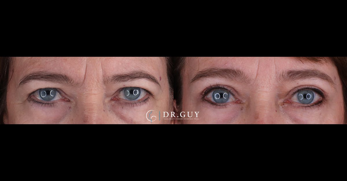Upper Blepharoplasty Before & After Gallery - Patient 125949 - Image 1