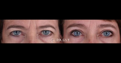 Browlift Before & After Gallery - Patient 252168 - Image 1
