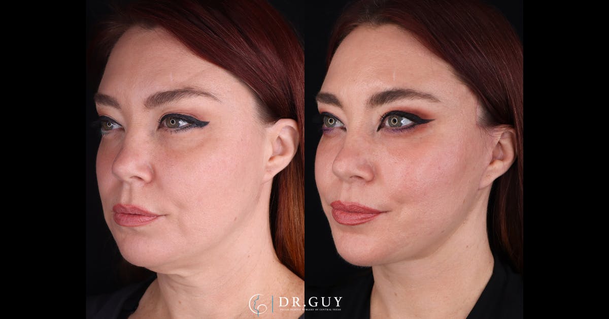 Facelift Before & After Gallery - Patient 342505 - Image 3