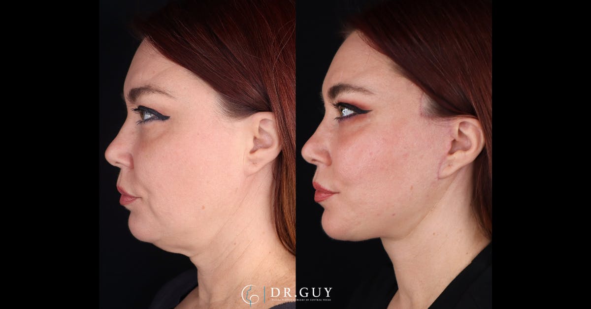 Facelift Before & After Gallery - Patient 342505 - Image 4