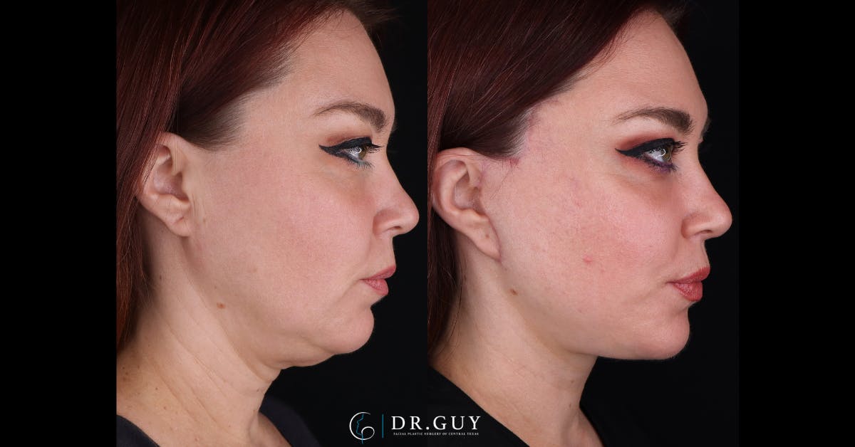 Facelift Before & After Gallery - Patient 342505 - Image 2