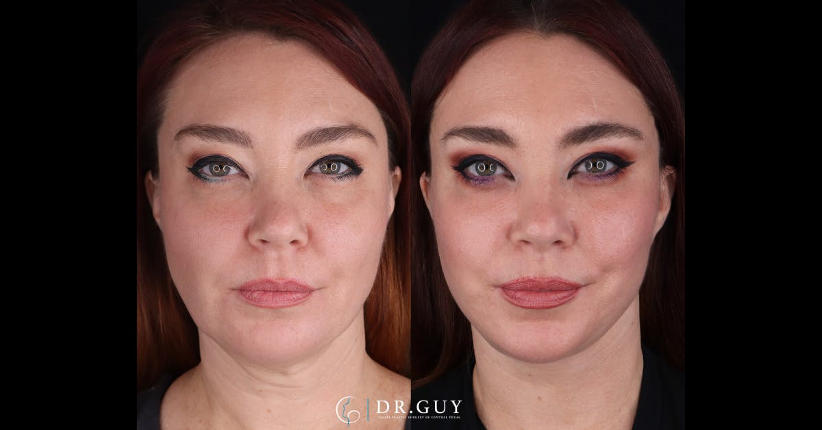 Facelift Before & After Gallery - Patient 342505 - Image 1