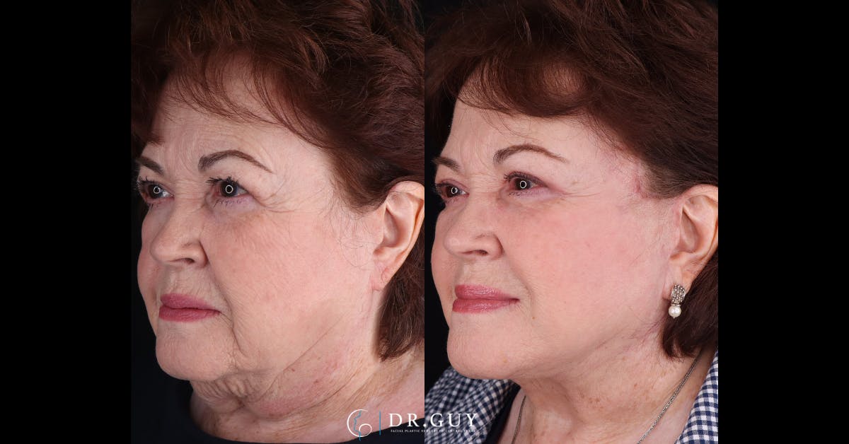 Facelift Before & After Gallery - Patient 356351 - Image 4