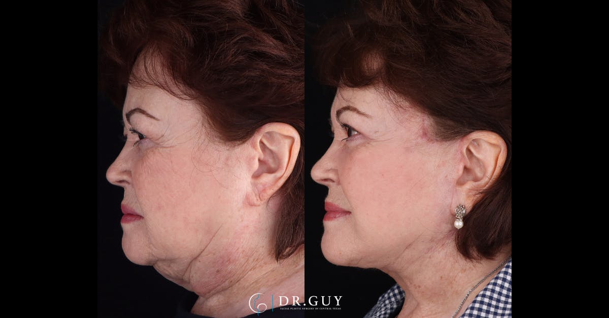 Facelift Before & After Gallery - Patient 356351 - Image 5