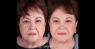 Facelift Before & After Gallery - Patient 356351 - Image 1
