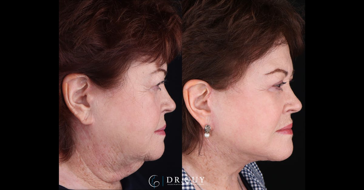 Facelift Before & After Gallery - Patient 356351 - Image 3