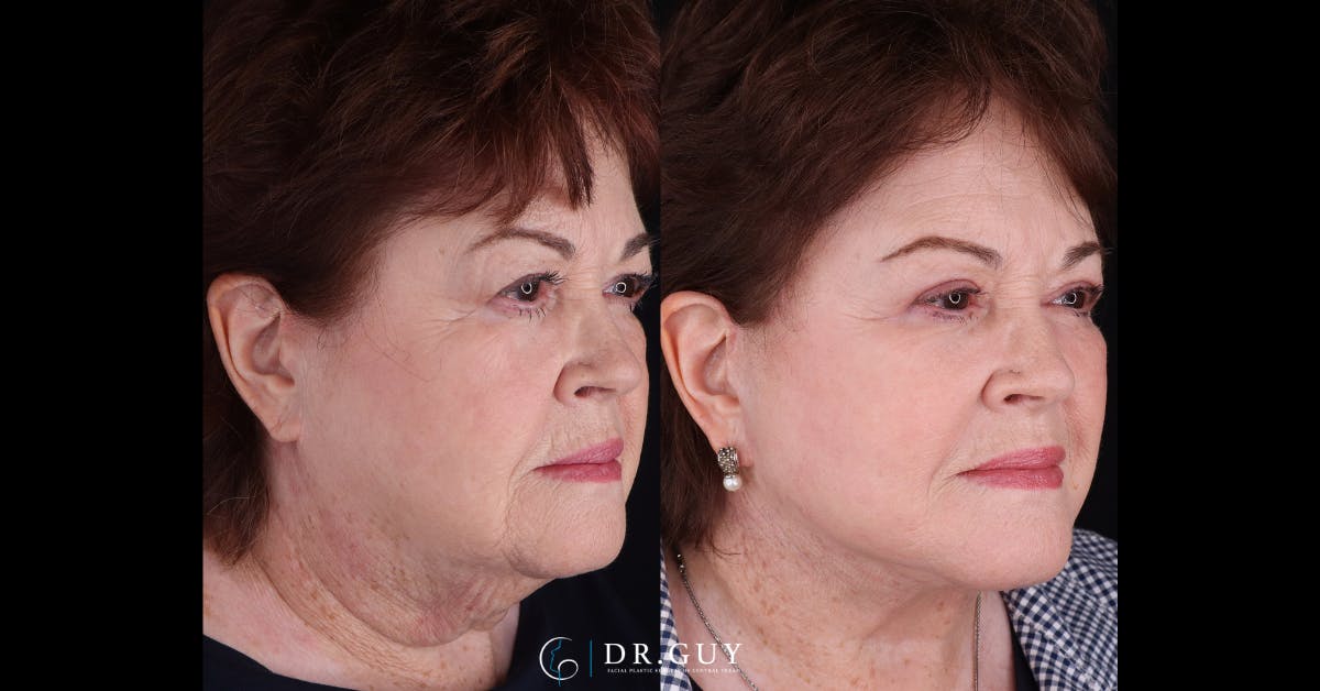 Facelift Before & After Gallery - Patient 356351 - Image 2