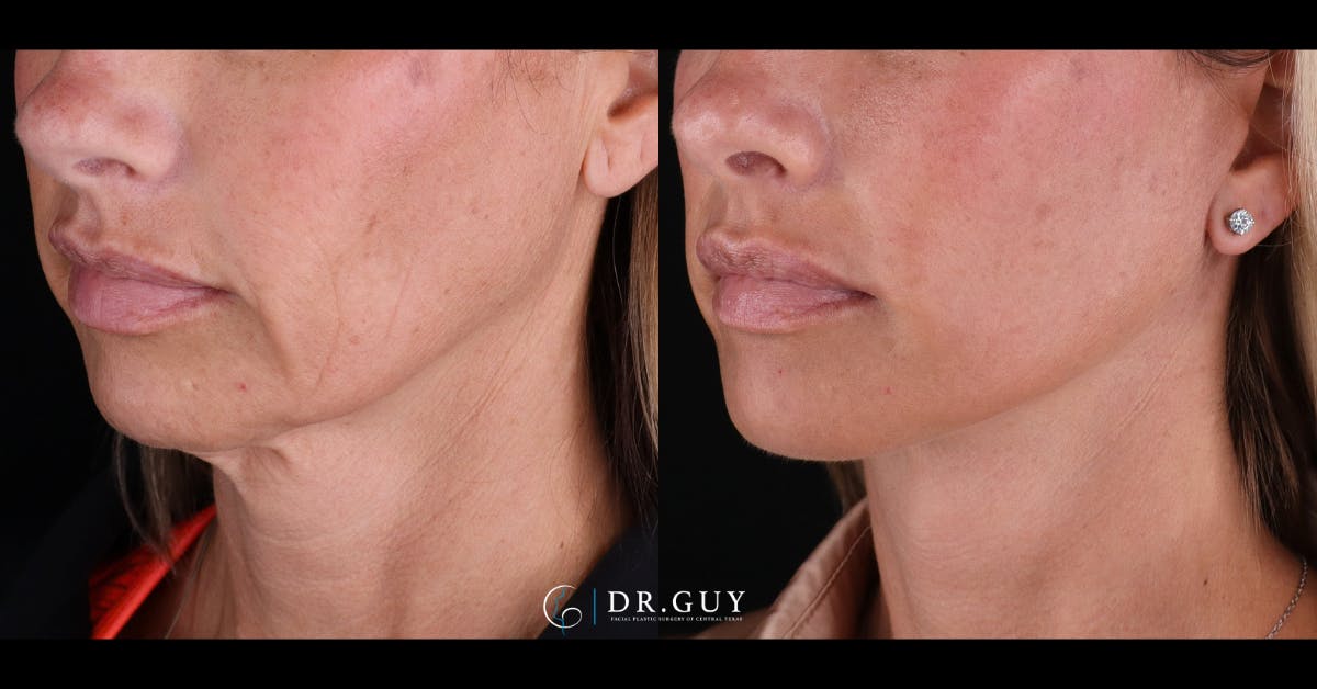 Facelift Before & After Gallery - Patient 399540 - Image 4