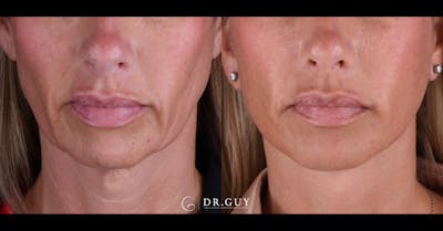 Facelift Before & After Gallery - Patient 399540 - Image 1