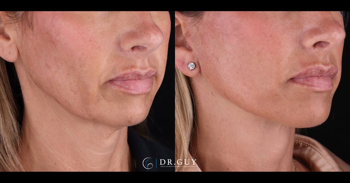 Facelift Before & After Gallery - Patient 399540 - Image 2