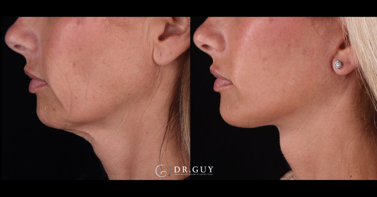 Facelift Before & After Gallery - Patient 399540 - Image 5