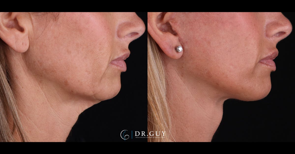Facelift Before & After Gallery - Patient 399540 - Image 3