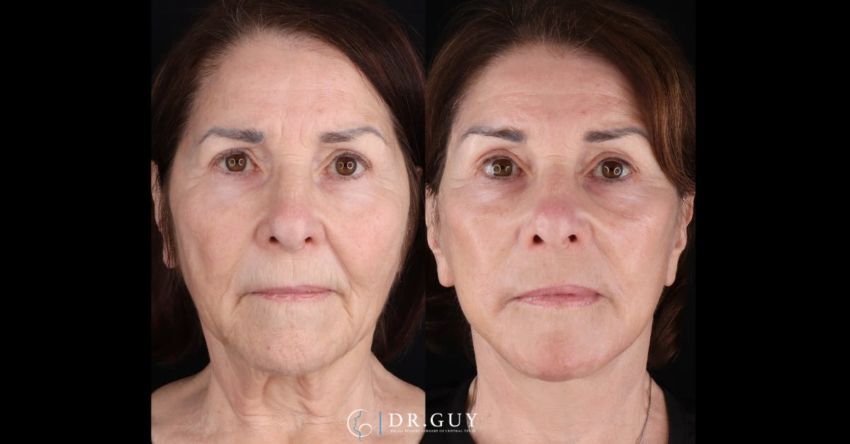 Facelift Before & After Gallery - Patient 282929 - Image 1