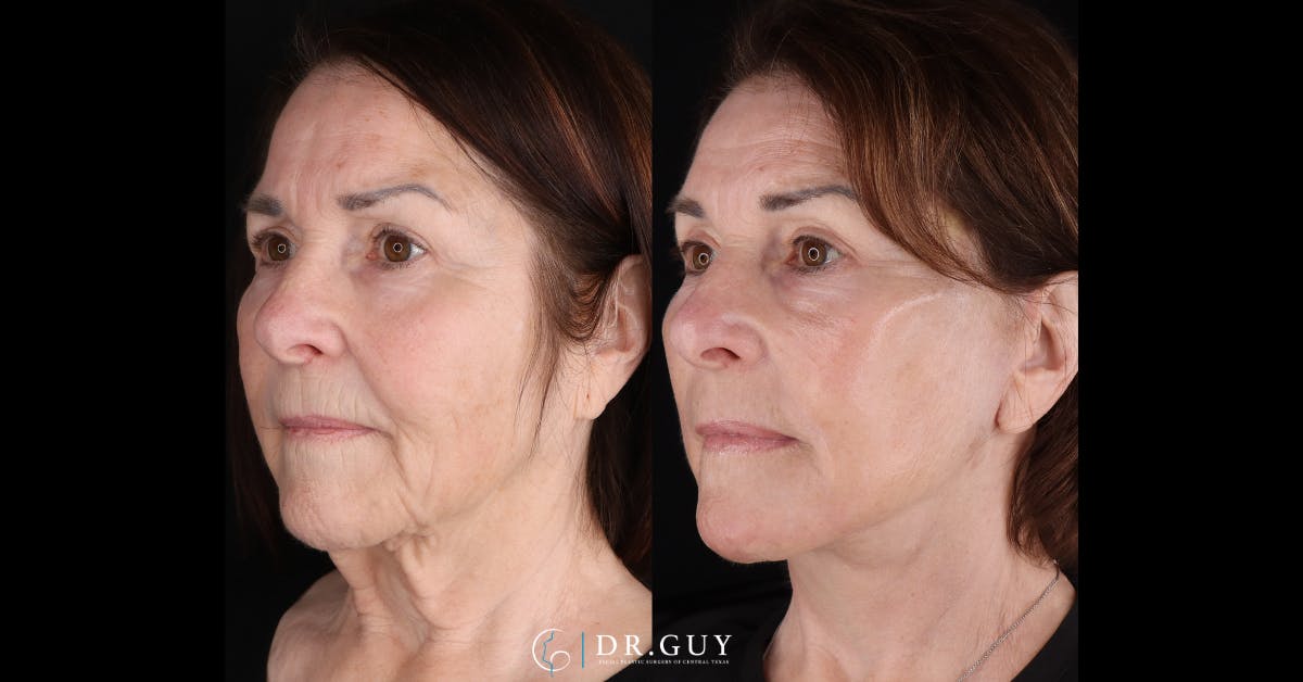 Facelift Before & After Gallery - Patient 282929 - Image 4