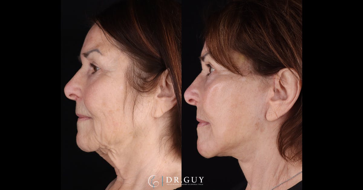Facelift Before & After Gallery - Patient 282929 - Image 5