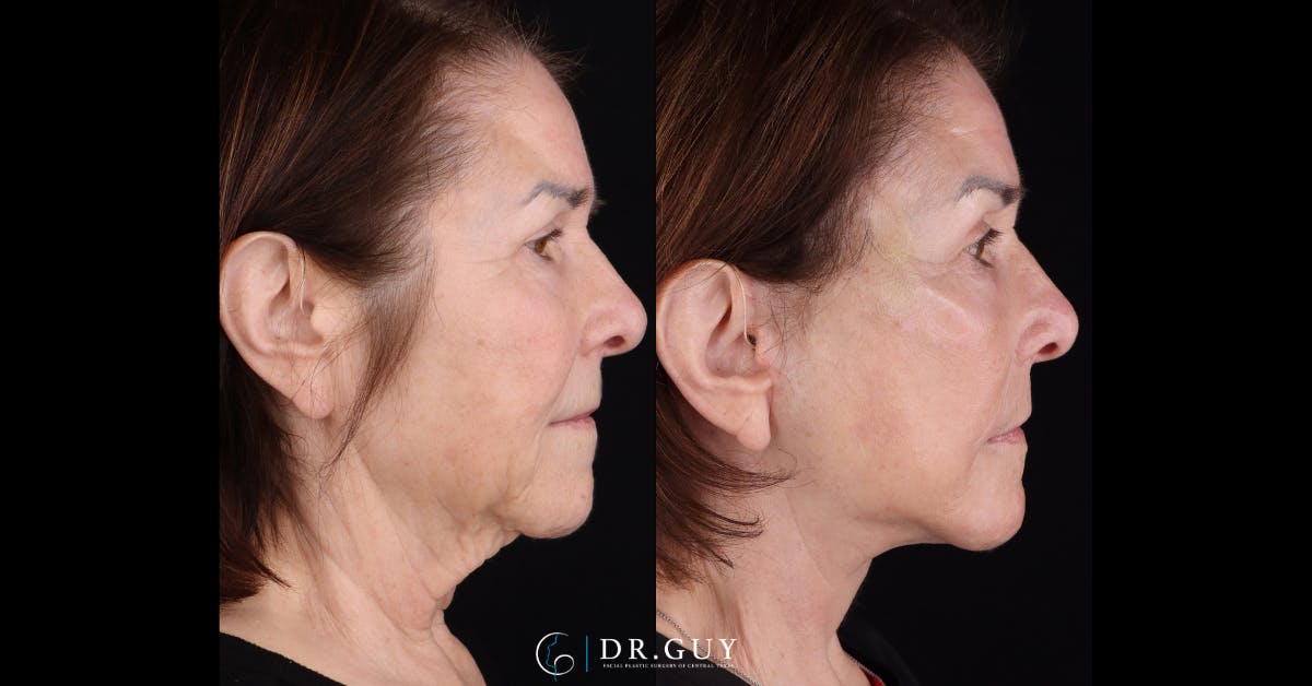 Facelift Before & After Gallery - Patient 282929 - Image 3