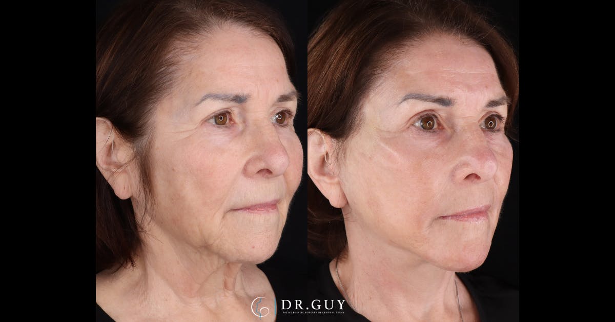 Facelift Before & After Gallery - Patient 282929 - Image 2