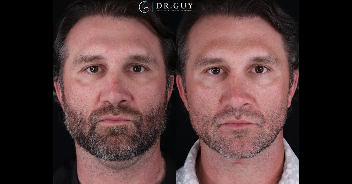 Neck Lift Before & After Gallery - Patient 827308 - Image 2