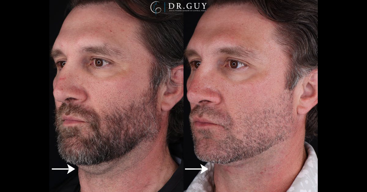 Neck Lift Before & After Gallery - Patient 827308 - Image 4