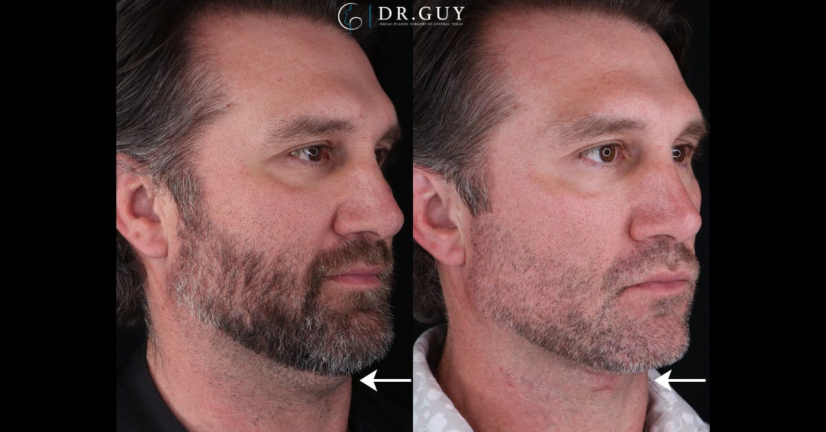 Neck Lift Before & After Gallery - Patient 827308 - Image 3