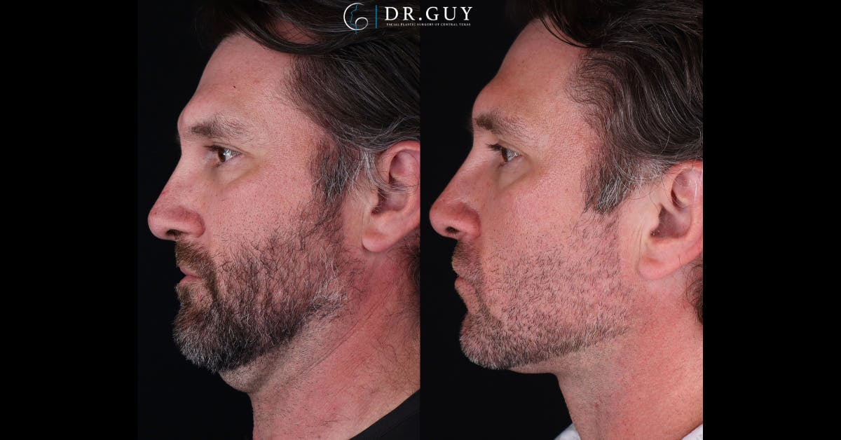 Neck Lift Before & After Gallery - Patient 827308 - Image 1
