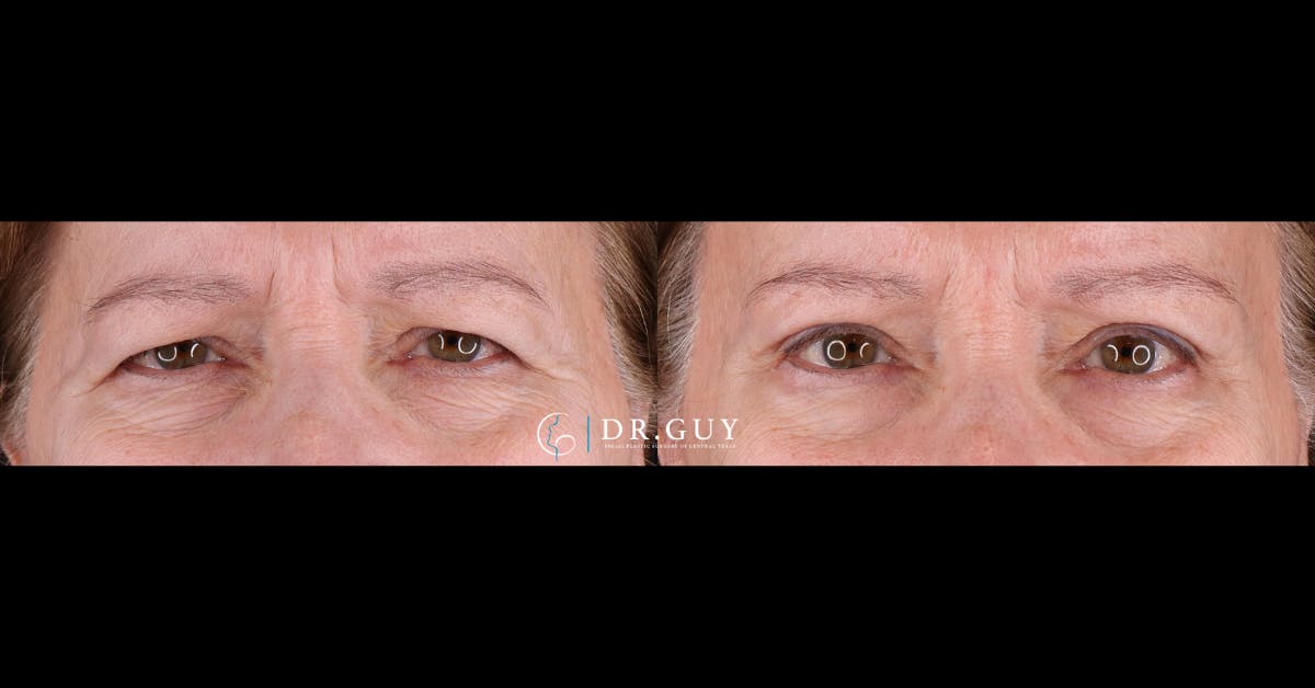 Browlift Before & After Gallery - Patient 367022 - Image 1