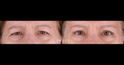 Browlift Before & After Gallery - Patient 367022 - Image 1