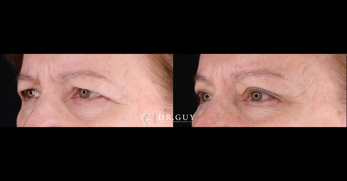 Browlift Before & After Gallery - Patient 367022 - Image 3