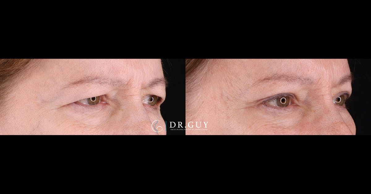 Browlift Before & After Gallery - Patient 367022 - Image 2